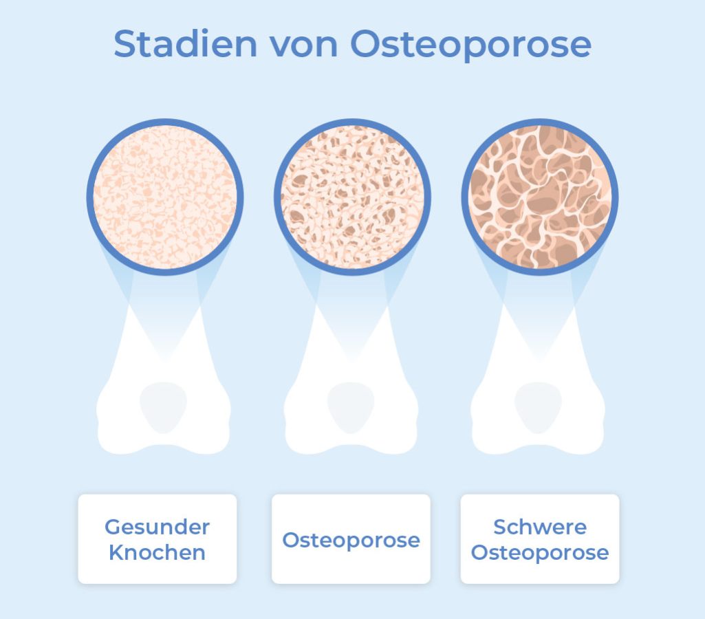 0486_FP_Knochendichtemessung_Osteoporose-Stadien_01